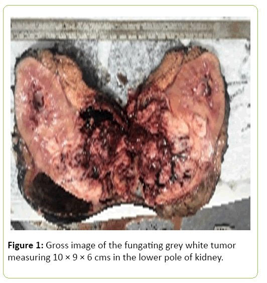 medical-clinical-reviews-Gross-image-fungating-grey-white-tumor