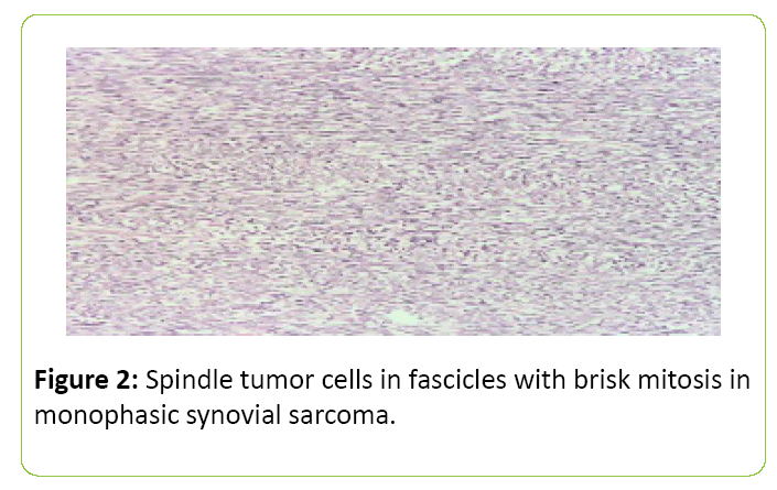 medical-clinical-reviews-Spindle-tumor-cells-fascicles-with-brisk-mitosis