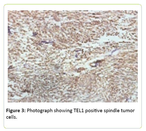 medical-clinical-reviews-TEL1-positive-spindle-tumor-cells