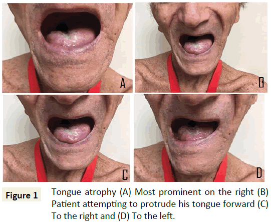 medical-clinical-reviews-Tongue-atrophy