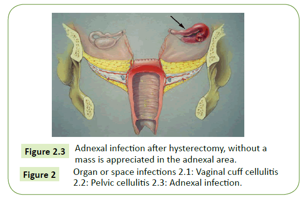 Vaginal Discharge after Hysterectomy